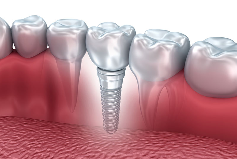 As 7 principais dúvidas sobre Implantes Dentários