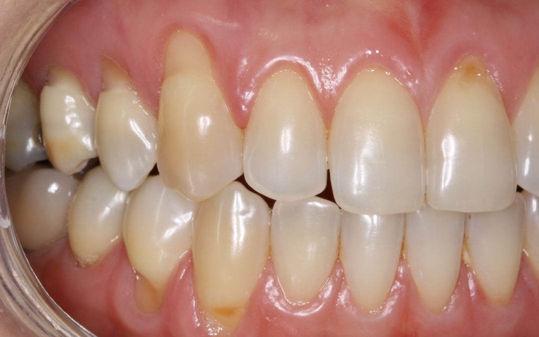 As 3 causas mais comuns de desgaste dos dentes