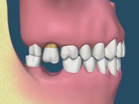 As consequências da perda dentária