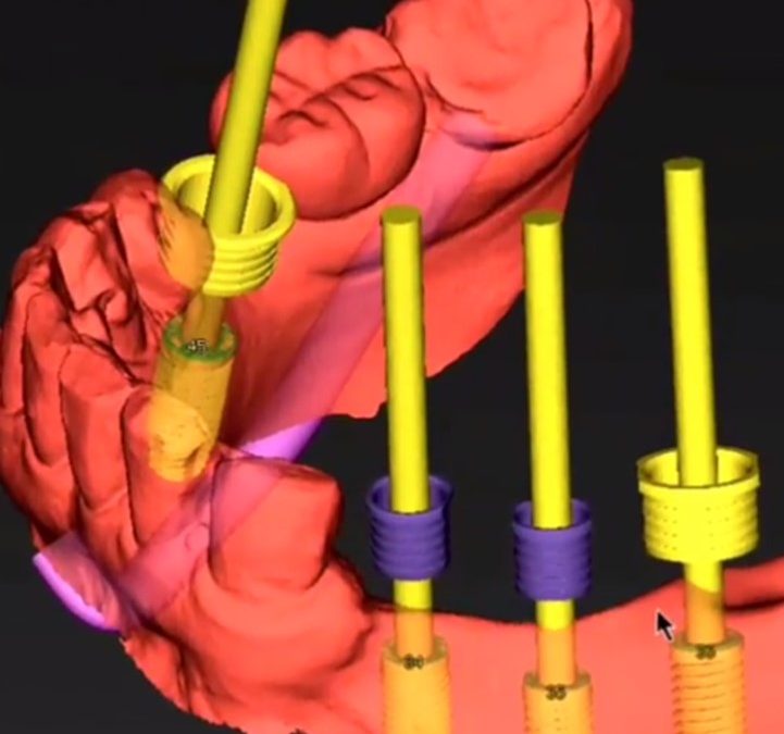 Cirurgia de Implante Guiada por Computador